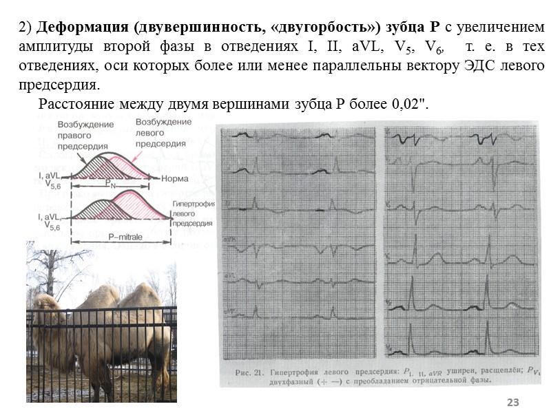 23 2) Деформация (двувершинность, «двугорбость») зубца Р с увеличением амплитуды второй фазы в отведениях 23 2) Деформация (двувершинность, «двугорбость») зубца Р с увеличением амплитуды второй фазы в отведениях